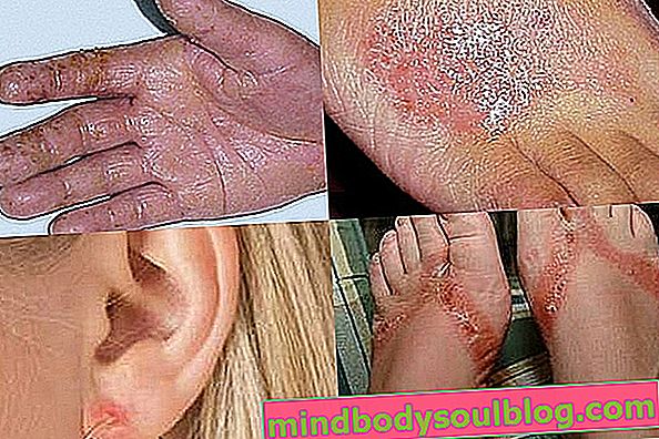 Dermatite de contact: qu'est-ce que c'est, symptômes, traitement et pommades