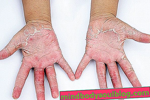 Allergie dans les mains: causes, symptômes et traitement