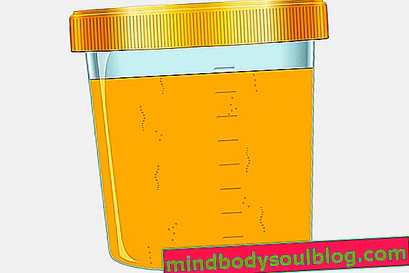 Que peut signifier la couleur de l'urine (urine jaune, blanche, orange)