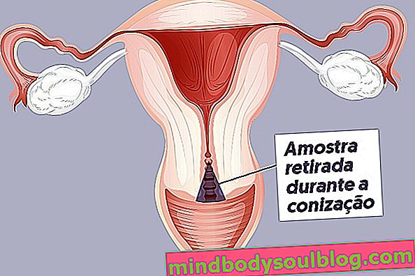 Conisation de l'utérus: à quoi sert-il et comment se déroule la guérison