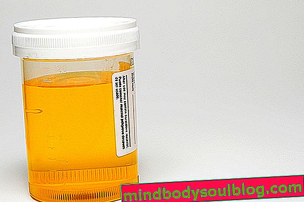 Cellules épithéliales dans l'urine: ce que cela peut être et comment comprendre le test