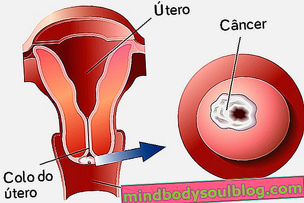 6 signes pouvant indiquer un cancer du col de l'utérus