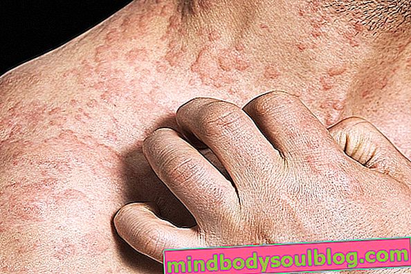 Алергія на холод: що це таке, основні симптоми та лікування