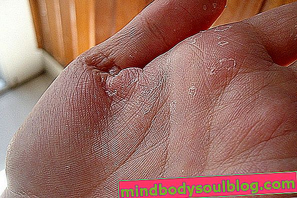 Alergi di tangan: penyebab, gejala dan pengobatan