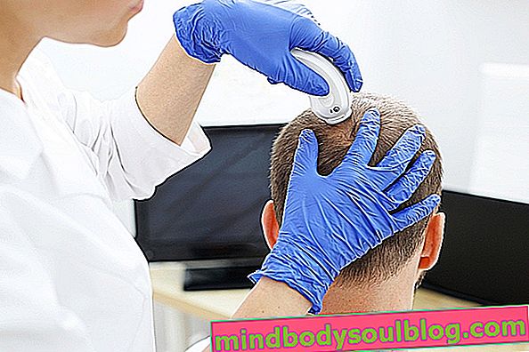 脱毛症を治療する5つの方法