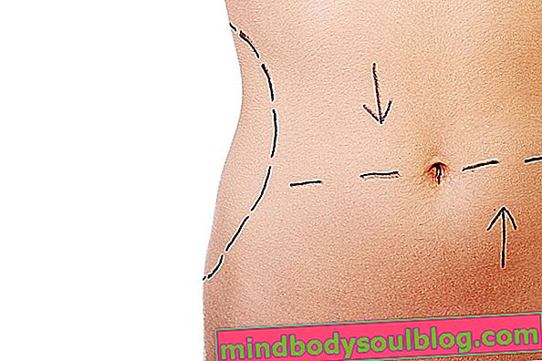 ミニ腹部形成術の方法と回復