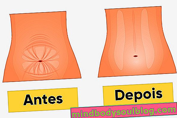 Comment se fait la mini-abdominoplastie et récupération