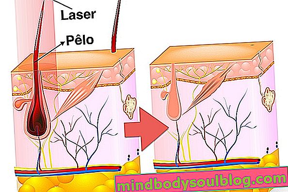 Cara Kerja Laser Penghilang Bulu