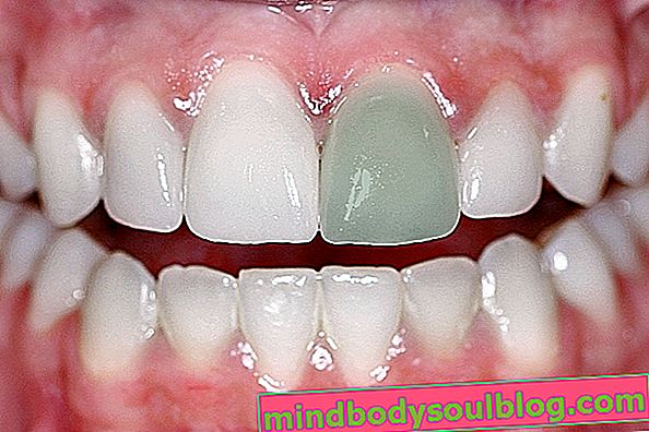 Was kann Zahn verdunkelt werden und wie wird die Behandlung durchgeführt