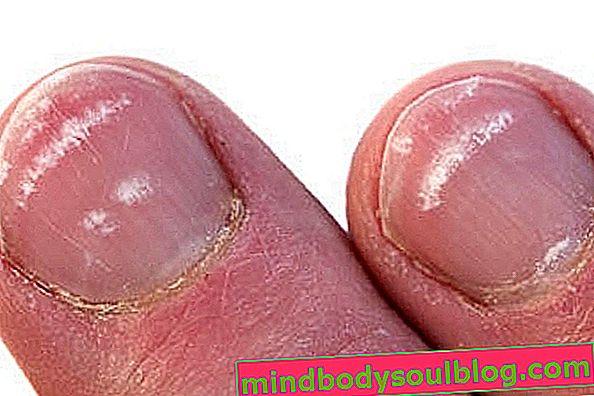 3. Białe plamy na paznokciach