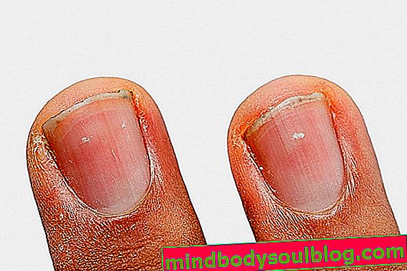 爪の白い斑点：爪の状態と対処方法