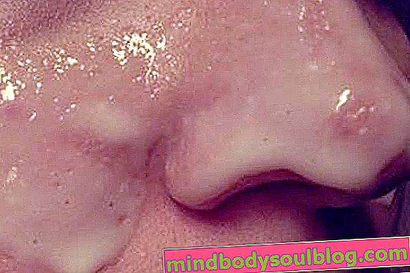皮膚からにきびを取り除く方法