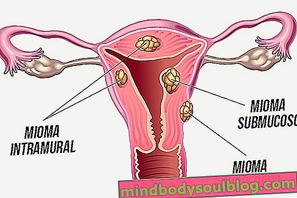 Remèdes pour les fibromes dans l'utérus