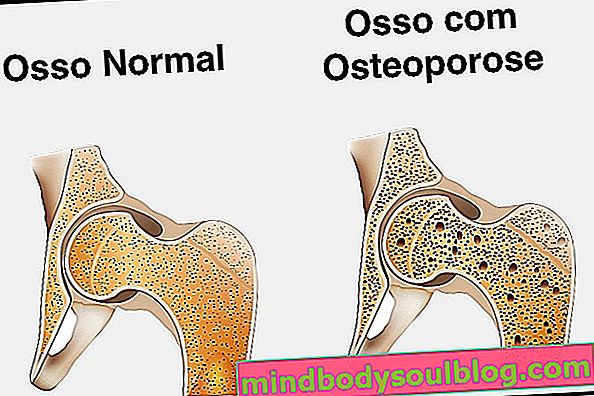 Средства за лечение на остеопороза