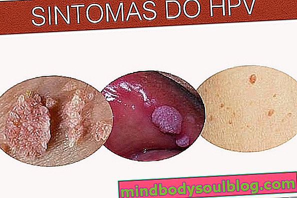 قد يكون مرهم Barbatimão هو العلاج لفيروس الورم الحليمي البشري