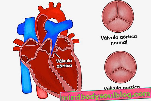 Qu'est-ce que la valve aortique bicuspide, pourquoi elle se produit et comment la traiter