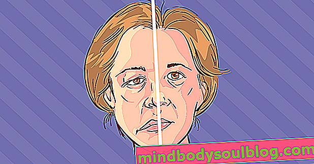 Kelumpuhan wajah: apa adanya, gejala, penyebab utama dan pengobatannya