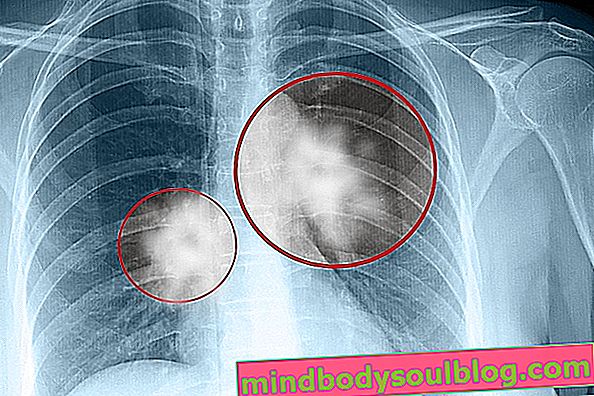 Bintik di paru-paru: 4 kemungkinan penyebab dan apa yang harus dilakukan