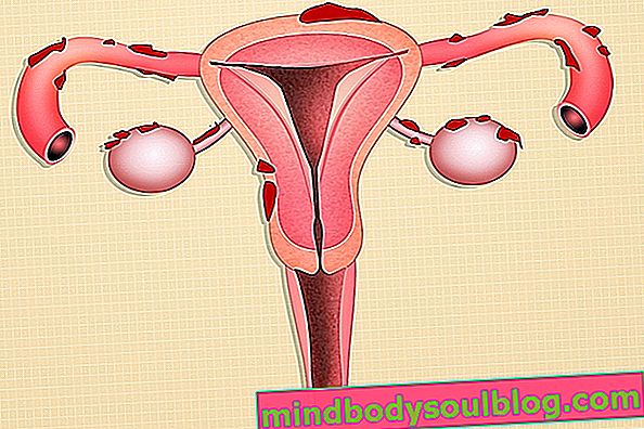 12 най-често срещани въпроса за ендометриозата