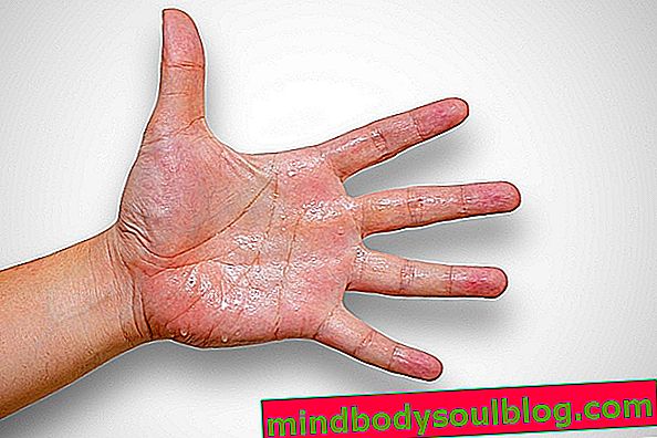 手に汗をかくための5つの治療オプション、主な原因、回避方法