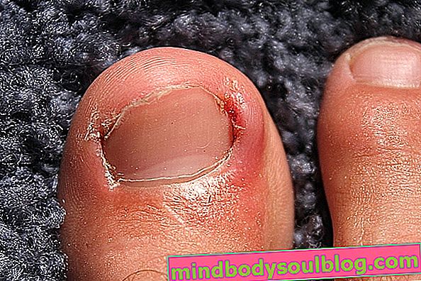 Хворі нігті: як доглядати та засоби