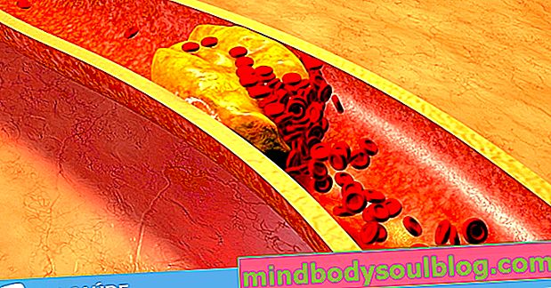 Cara menurunkan kolesterol jahat (LDL)