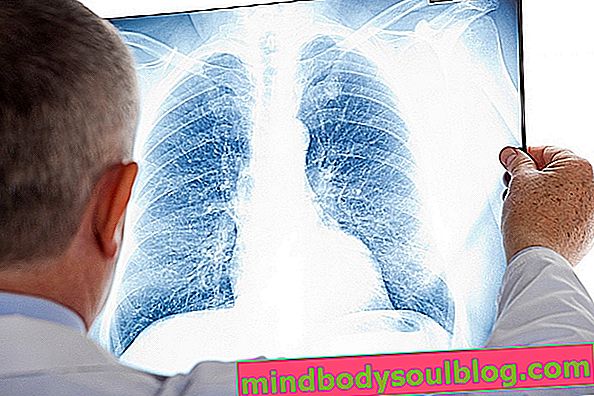 Jak leczy się zapalenie płuc