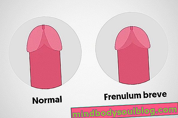 Кратък френулум: как да се идентифицира и кога да се оперира