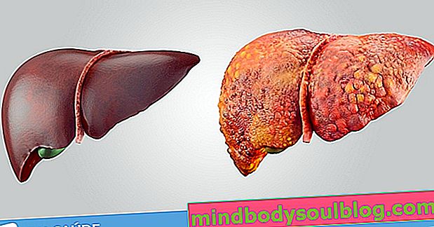 肝臓の脂肪のための食事療法