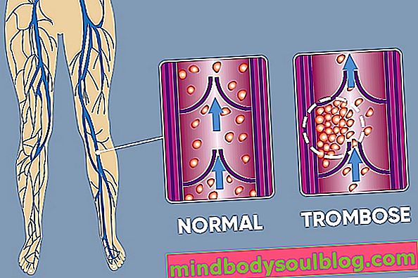Qu'est-ce qu'une thrombose, principaux symptômes et traitement