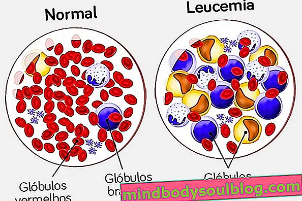 Qu'est-ce que la leucémie aiguë, les symptômes et le traitement