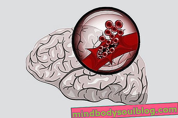النزف الدماغي: الأعراض والأسباب والعواقب المحتملة