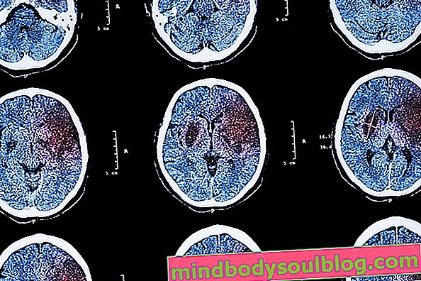 Hémorragie cérébrale: symptômes, causes et séquelles possibles