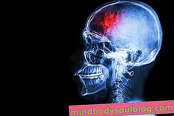 Perdarahan otak: gejala, penyebab dan kemungkinan gejala sisa