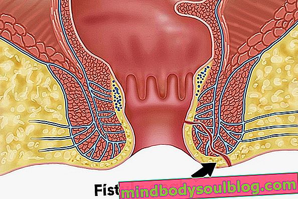 Fistule anale / périanale: qu'est-ce que c'est, symptômes et quand se faire opérer