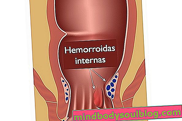 Hémorroïdes: ce qu'elles sont, quel est le traitement et les principaux symptômes