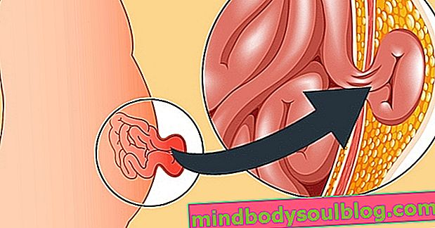 Symptômes de la hernie abdominale et principales causes