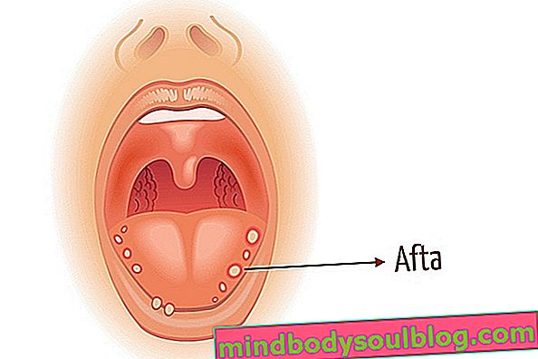 מחלת הפה והפה: תסמינים, סיבות וטיפול