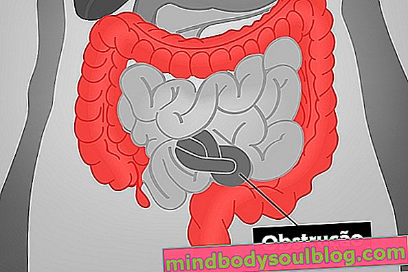 Qu'est-ce que l'obstruction intestinale, les principaux symptômes et le traitement