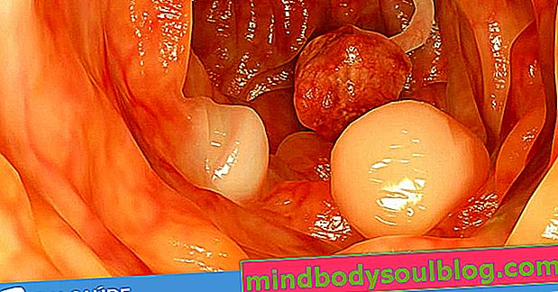Qu'est-ce que le polype intestinal, les symptômes, les causes et le traitement