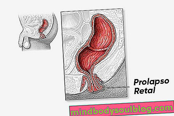 Qu'est-ce que le prolapsus rectal, ses causes, ses symptômes et son traitement