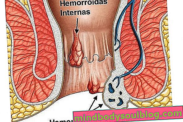 6 възможности за лечение на външни хемороиди