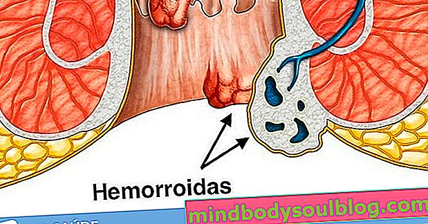 Qu'est-ce que les hémorroïdes externes, les principales causes et le traitement