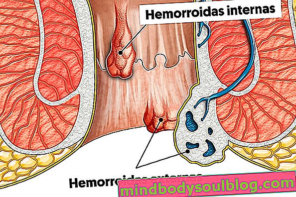 Qu'est-ce que les hémorroïdes externes, les principales causes et le traitement