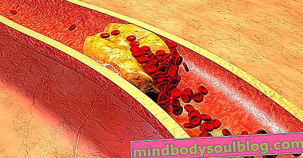 4 Tipps zur Erhöhung des guten Cholesterins