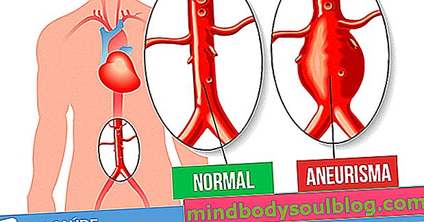 Anévrisme aortique: qu'est-ce que c'est, symptômes, causes et traitement