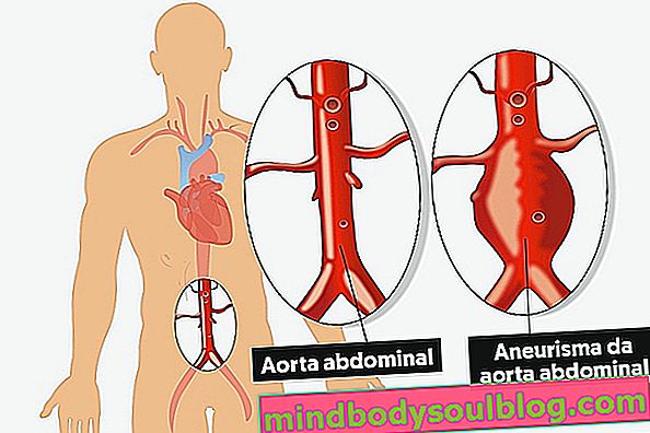 Aortenaneurysma: Was es ist, Symptome, Ursachen und Behandlung