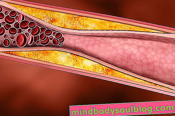 Qu'est-ce que l'athéromatose aortique, ses symptômes et comment le traiter