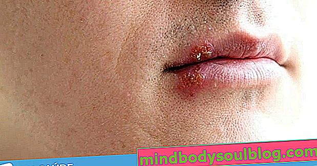 Ketahui gejala dan cara mengobati herpes mulut