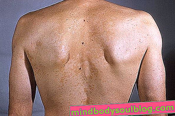 Tompok-tompok putih pada kulit: 7 kemungkinan penyebab dan bagaimana menyingkirkannya